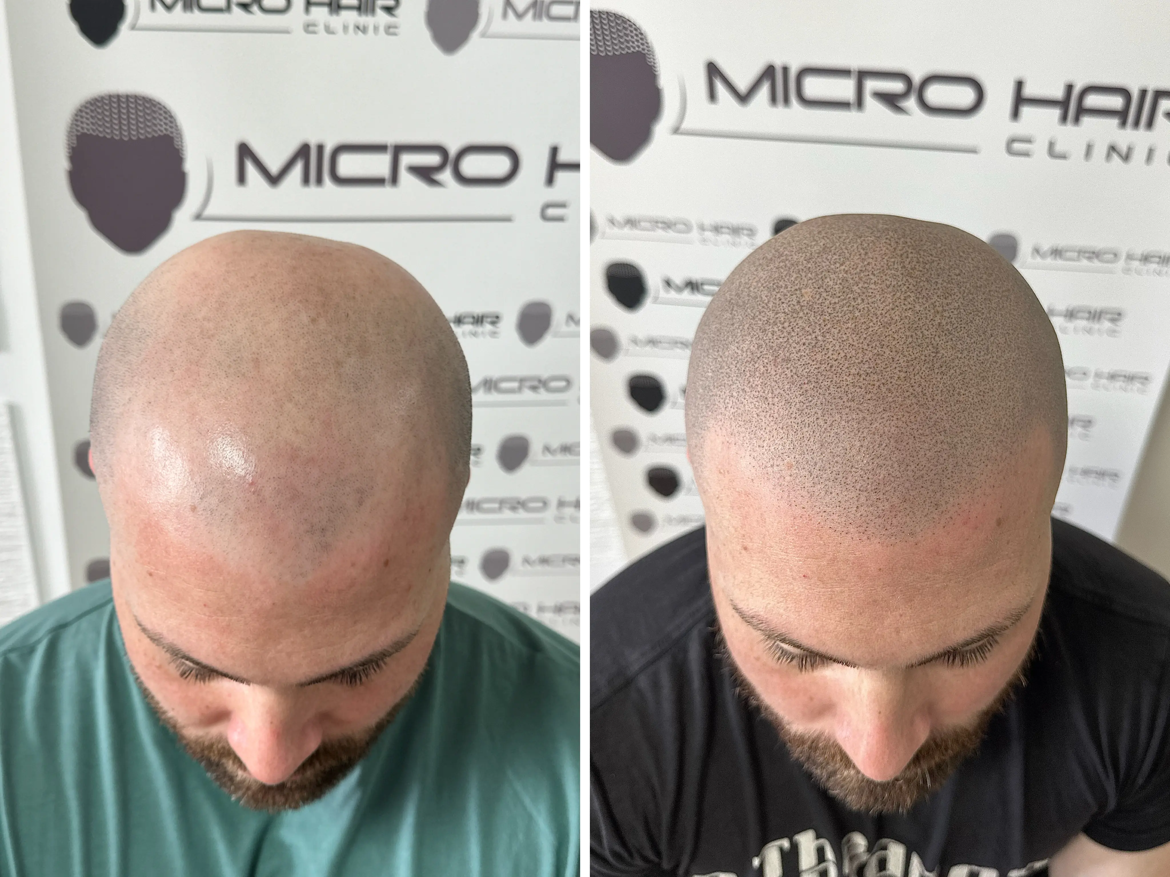 SMP rezultat pred in po - tretman mikropigmentacije 13